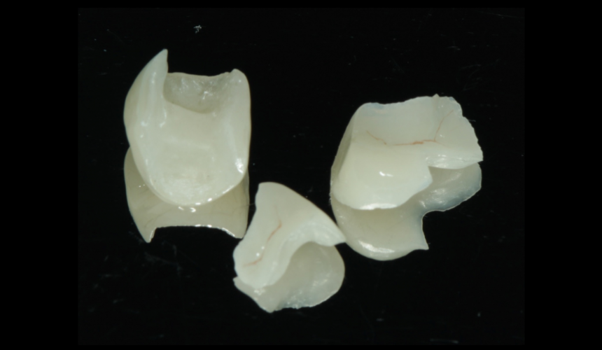 藍瓷貼面、嵌體